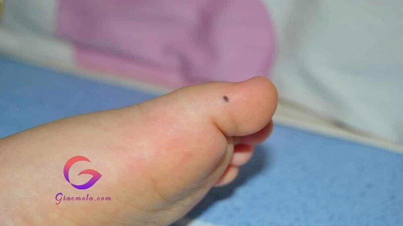 Nốt ruồi ở vị trí ngón chân trái